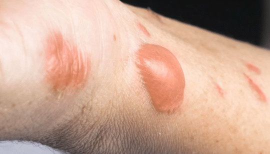 Deciphering The Symptoms Of Blisterata 